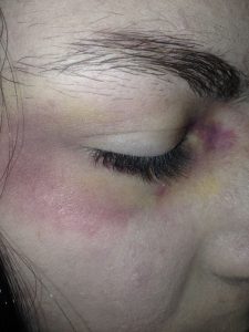 Die attackierte Antifaschistin postete Fotos ihrer Verletzungen auf Facebook...